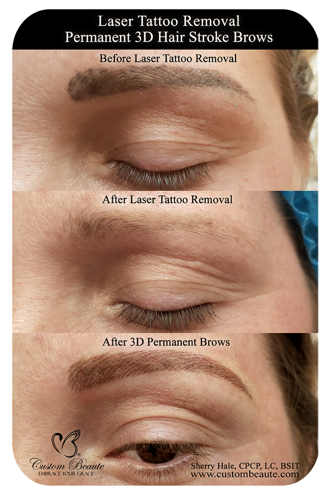 Laser Tattoo Removal and Permanent Brows