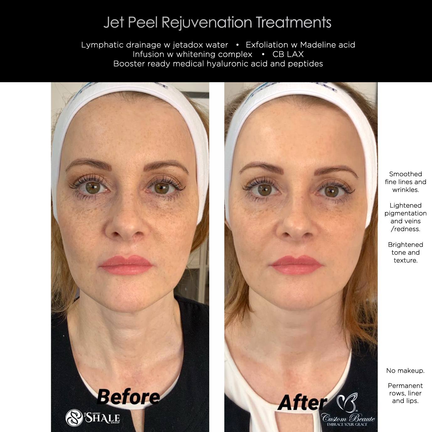 Before and After Jet Peel Rejuvenation Treatment in Amherst New York