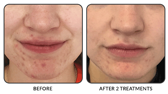 Active acne reduction